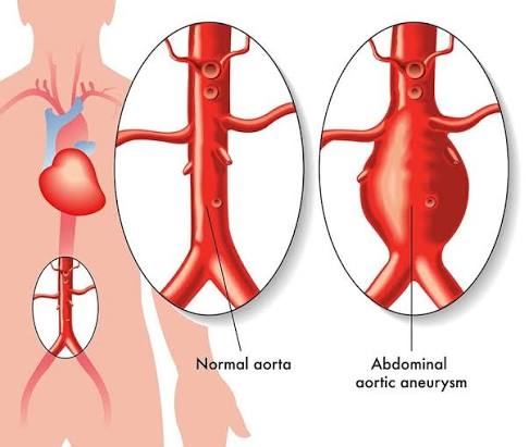 Illustration comparing a normal abdominal aorta with an abdominal aortic aneurysm